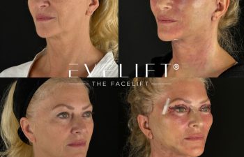 female patient before and after EVELIFT®