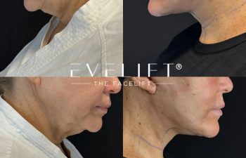 female patient before and after EVELIFT®