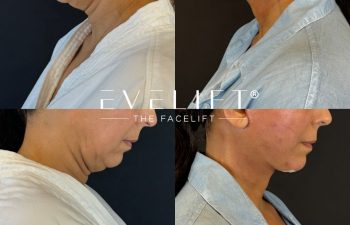 female patient before and after EVELIFT®