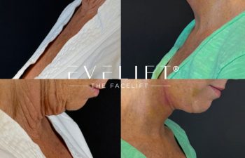 female patient before and after EVELIFT®