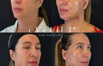 female patient before and after EVELIFT®