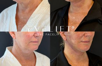 female patient before and after EVELIFT®
