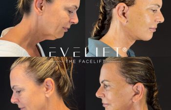 female patient before and after EVELIFT®