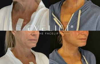 female patient before and after EVELIFT®