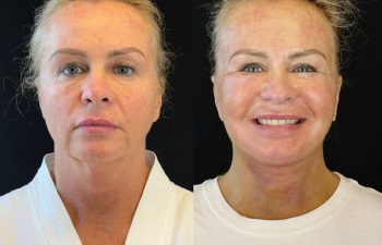 female patient before and after EVELIFT®