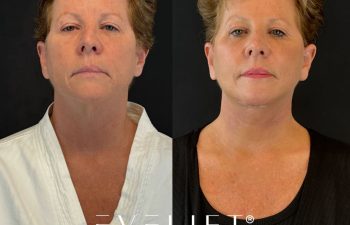 female patient before and after EVELIFT®