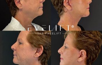 female patient before and after EVELIFT®