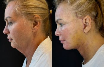 female patient before and after EVELIFT®