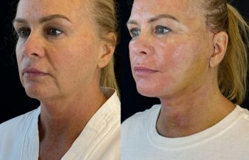 female patient before and after EVELIFT®