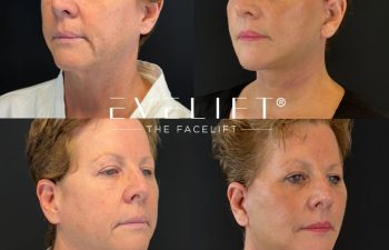 female patient before and after EVELIFT®