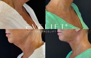 female patient before and after EVELIFT®