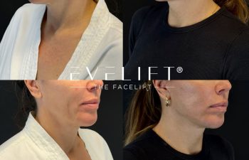 female patient before and after EVELIFT®