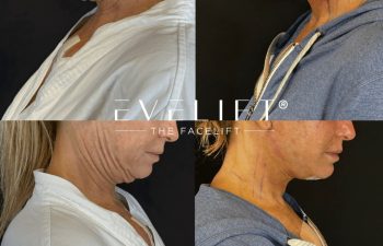 female patient before and after EVELIFT®