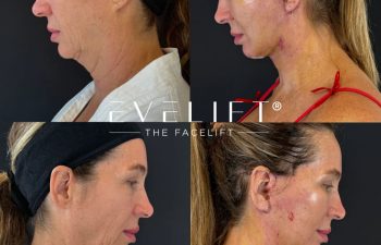 female patient before and after EVELIFT®