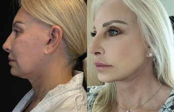 female patient before and after EVELIFT®