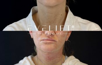 female patient before and after EVELIFT®