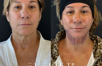 female patient before and after EVELIFT®