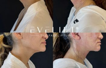 female patient before and after EVELIFT®