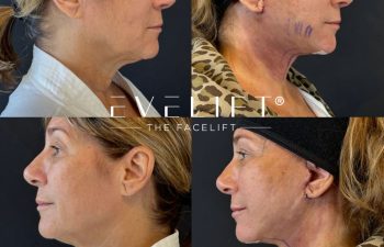 female patient before and after EVELIFT®