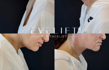 female patient before and after EVELIFT®
