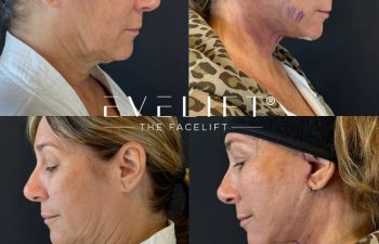 female patient before and after EVELIFT®