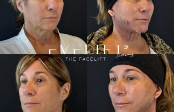 female patient before and after EVELIFT®