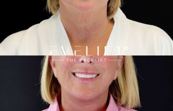 female patient before and after EVELIFT®