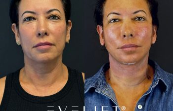 female patient before and after EVELIFT®