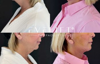 female patient before and after EVELIFT®