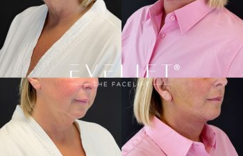 female patient before and after EVELIFT®