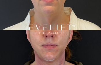 female patient before and after EVELIFT®