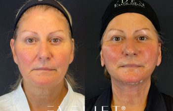 female patient before and after EVELIFT®