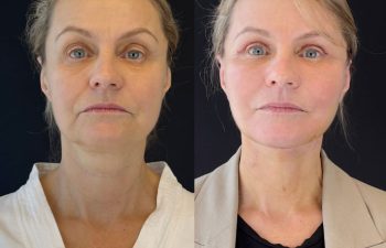 female patient before and after EVELIFT®
