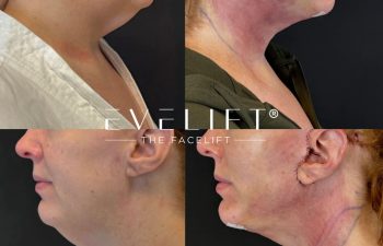 female patient before and after EVELIFT®