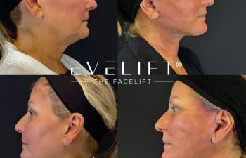 female patient before and after EVELIFT®