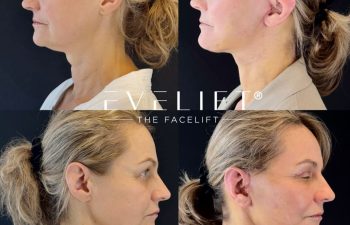 female patient before and after EVELIFT®