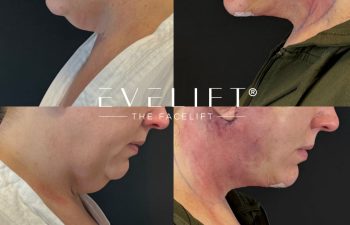 female patient before and after EVELIFT®