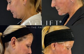 female patient before and after EVELIFT®