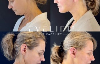 female patient before and after EVELIFT®