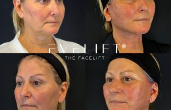 female patient before and after EVELIFT®