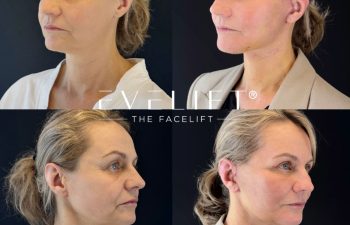 female patient before and after EVELIFT®