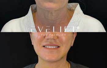 female patient before and after EVELIFT®