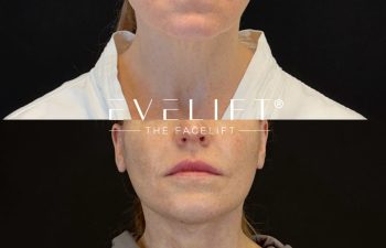 female patient before and after EVELIFT®