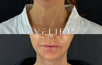 female patient before and after EVELIFT®