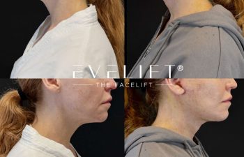 female patient before and after EVELIFT®