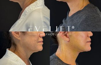 female patient before and after EVELIFT®