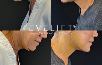 female patient before and after EVELIFT®