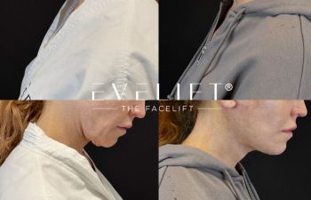 female patient before and after EVELIFT®