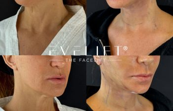 female patient before and after EVELIFT®