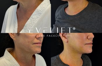 female patient before and after EVELIFT®